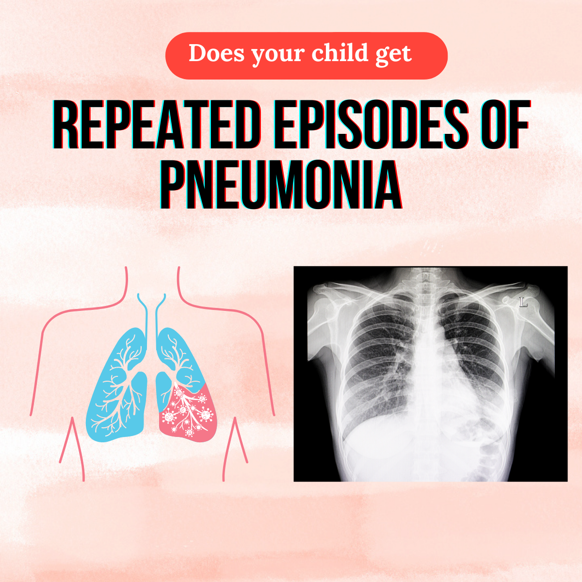 Why does my child get repeated episodes of Pneumonia Dr. Ankit Parakh
