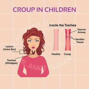 Croup in Children - Symptoms, Diagnosis and treatment