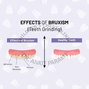 Teeth Grinding or Bruxism in Children